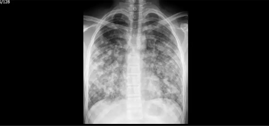 The WOPR Learns About Pneumonia in Children