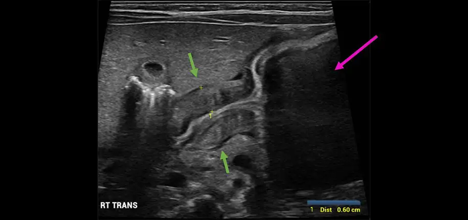 Pyloric Stenosis, What does that mean?