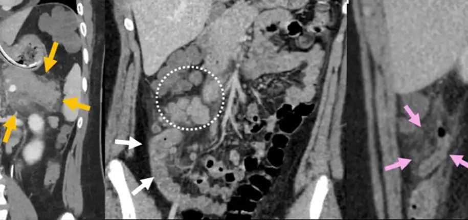 What is Multisystem Inflammatory Syndrome in Children (MIS-C)?