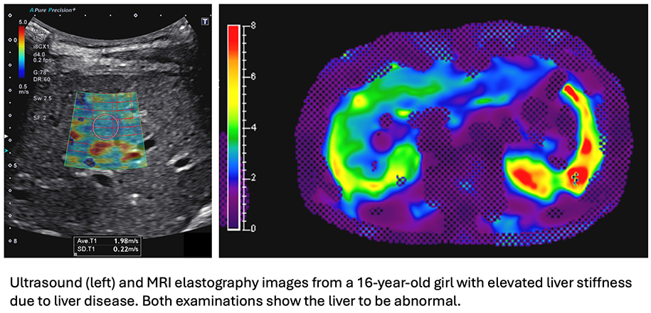 Radiology Faculty and Former Research Fellow Featured in RSNA News on Imaging Fatty Liver Disease in Children 