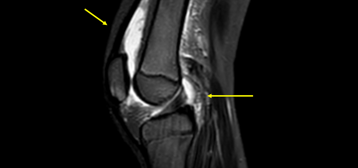 Rapid MRI for Acute Musculoskeletal Infection Protocol