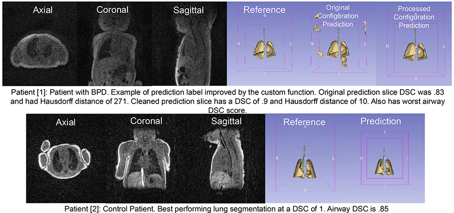 Advancing Neonatal Imaging: Cincinnati Children’s AI Imaging Research Center Showcases AI-Powered MRI Segmentation at Research Event 