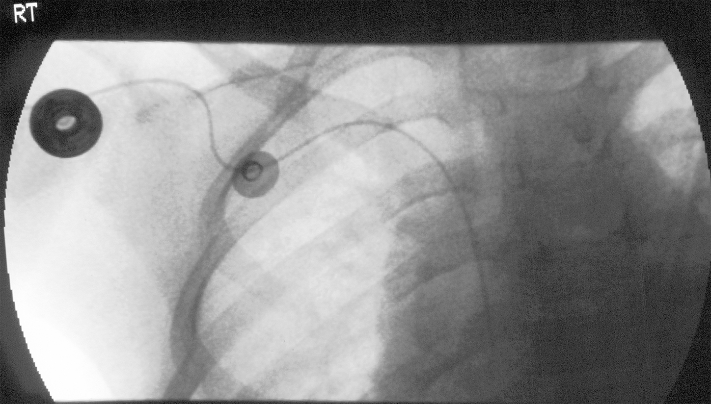 Using Central Lines for Contrast Injections in Radiology 
