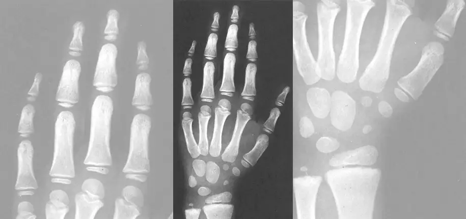 What Parents Should Know About New AI Research in Bone Age Testing 