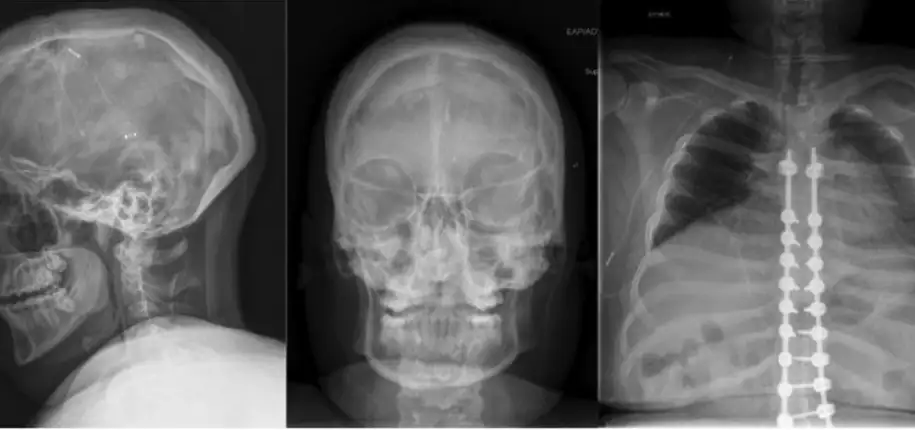 What Families Should Know About CSF Shunt Imaging: New Research May Help Shorten Testing Times 